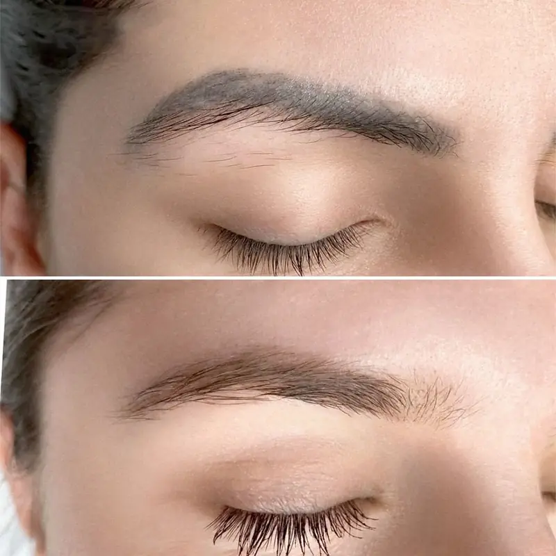 Permanent Makeup Removal