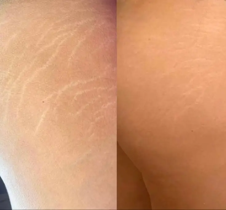 Stretch Marks Removal